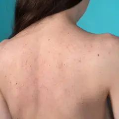 Schiena di una persona con inestetismi cutanei, tra cui brufoli e nei, su sfondo blu.