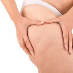 Mani che stringono la coscia, mostrando la texture della pelle e i noduli di cellulite, in un gesto che evoca il desiderio di rompere i noduli di cellulite.