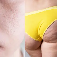 Close-up of skin texture: pitted facial skin on the left, dimpled thigh and buttocks in yellow underwear on the right.