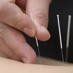 Mani esperte inseriscono aghi sottili, individuando i punti agopuntura per mal di schiena, per un sollievo naturale.