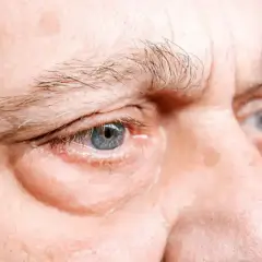 Occhi con borse evidenti, un segno che la medicina cinese potrebbe interpretare come squilibrio energetico.
