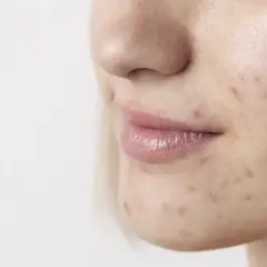 Primo piano del viso di una giovane donna con imperfezioni e smagliature sul viso, che evidenziano la texture della pelle.