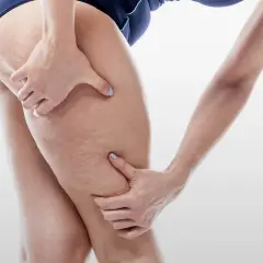 Mani che stringono la coscia, evidenziando la pelle con aspetto a buccia d'arancia, sintomo di ritenzione idrica grave.