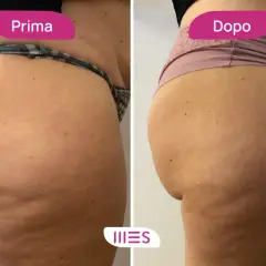 Prima e dopo: miglioramento della cellulite grazie all'ozonoterapia. Scopri il ozonoterapia cellulite costo per un corpo più liscio.