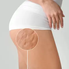Primo piano della coscia di una donna con cellulite fibrosa visibile, evidenziata da un cerchio.