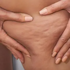 Mani che stringono la pelle mostrando la cellulite edematosa e fibrosa, con rugosità evidenti.