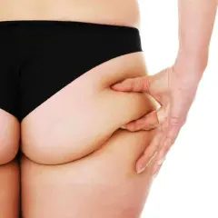 Mano che pizzica la pelle sui glutei, mostrando i banana rolls.