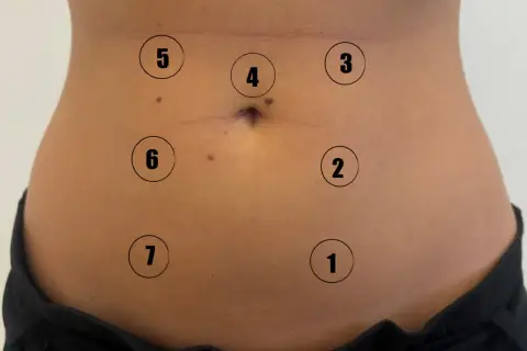 Close-up of a person's abdomen with numbered circles indicating points on the skin.
