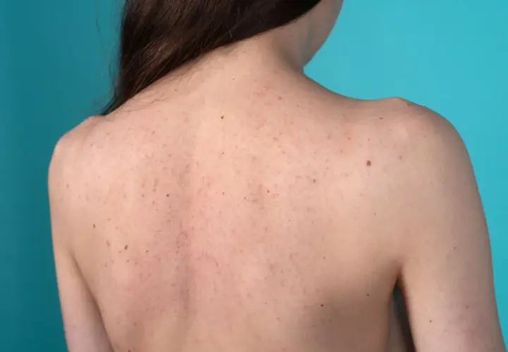 Schiena di una persona con inestetismi cutanei, tra cui brufoli e nei, su sfondo blu.