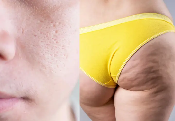 Close-up of skin texture: pitted facial skin on the left, dimpled thigh and buttocks in yellow underwear on the right.