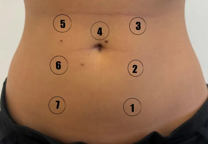Close-up of a person's abdomen with numbered circles indicating points on the skin.