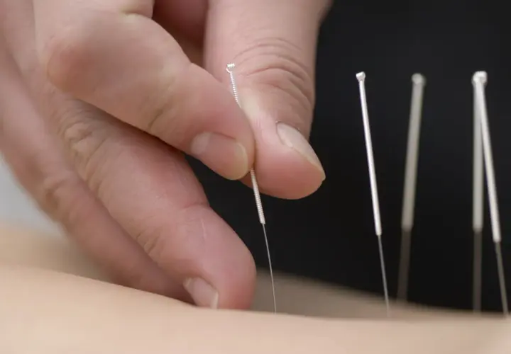 Mani esperte inseriscono aghi sottili, individuando i punti agopuntura per mal di schiena, per un sollievo naturale.