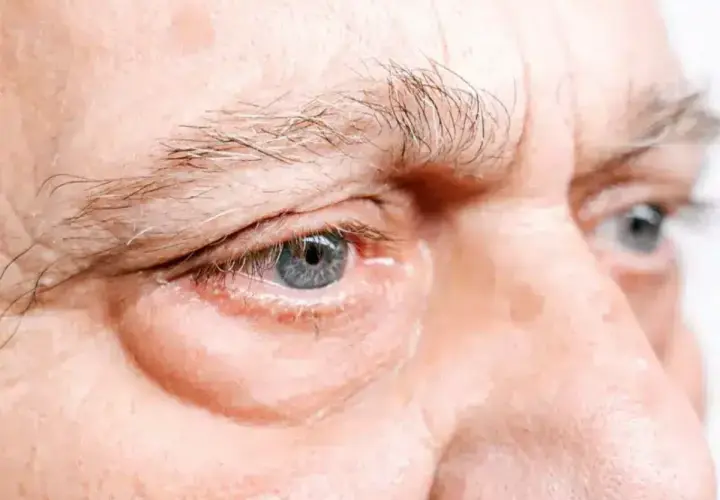 Occhi con borse evidenti, un segno che la medicina cinese potrebbe interpretare come squilibrio energetico.