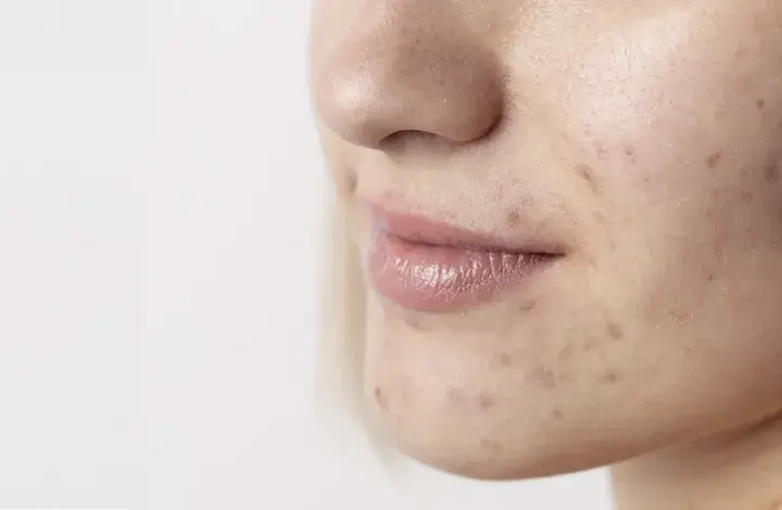 Primo piano del viso di una giovane donna con imperfezioni e smagliature sul viso, che evidenziano la texture della pelle.