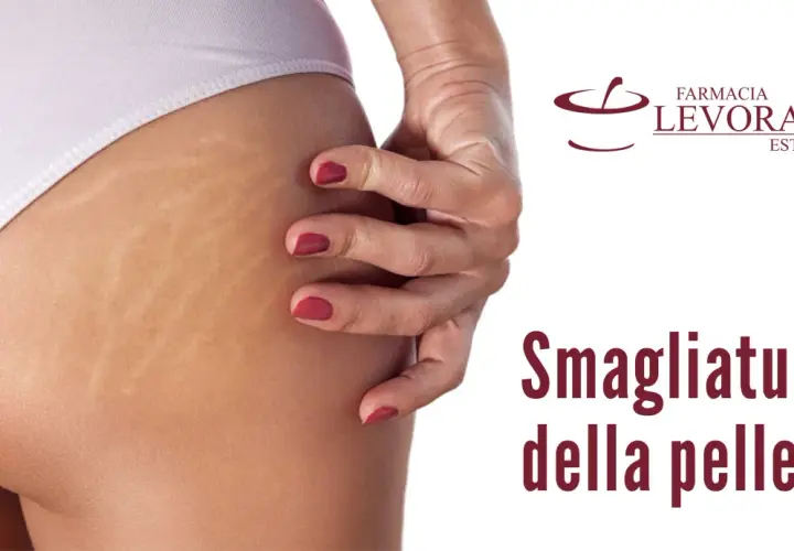 Primo piano di smagliature sull'interno coscia, un inestetismo comune della pelle.