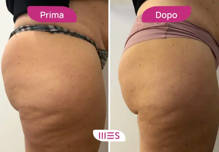 Prima e dopo: miglioramento della cellulite grazie all'ozonoterapia. Scopri il ozonoterapia cellulite costo per un corpo più liscio.