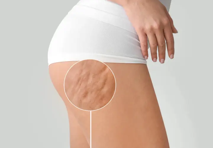 Primo piano della coscia di una donna con cellulite fibrosa visibile, evidenziata da un cerchio.
