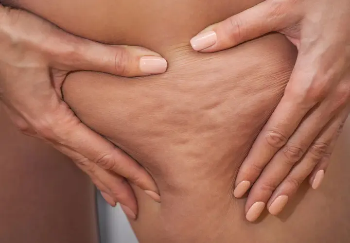 Mani che stringono la pelle mostrando la cellulite edematosa e fibrosa, con rugosità evidenti.