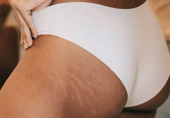Dettaglio di una coscia con smagliature gravidanza, segno di trasformazione e bellezza naturale.