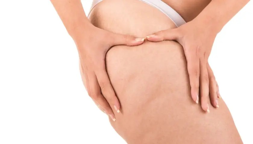 Mani che stringono la coscia, mostrando la texture della pelle e i noduli di cellulite, in un gesto che evoca il desiderio di rompere i noduli di cellulite.