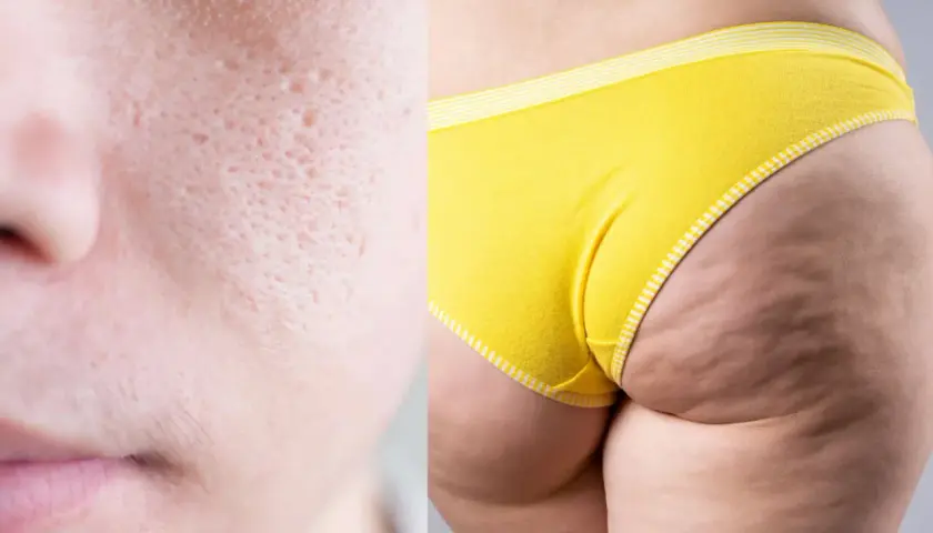 Close-up of skin texture: pitted facial skin on the left, dimpled thigh and buttocks in yellow underwear on the right.