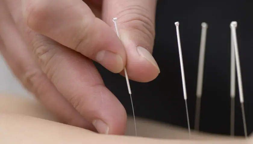 Mani esperte inseriscono aghi sottili, individuando i punti agopuntura per mal di schiena, per un sollievo naturale.