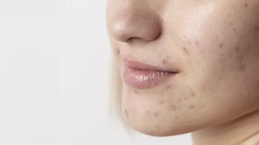 Primo piano del viso di una giovane donna con imperfezioni e smagliature sul viso, che evidenziano la texture della pelle.