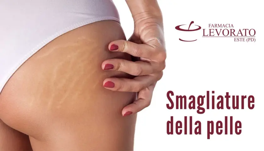 Primo piano di smagliature sull'interno coscia, un inestetismo comune della pelle.