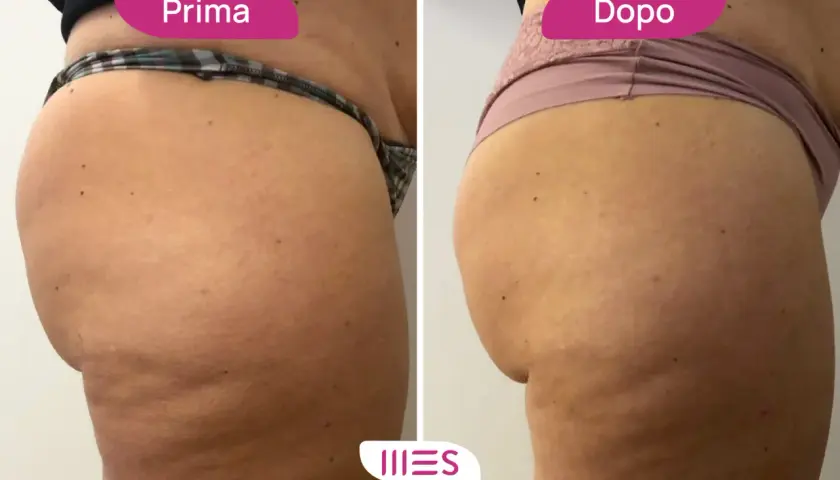 Prima e dopo: miglioramento della cellulite grazie all'ozonoterapia. Scopri il ozonoterapia cellulite costo per un corpo più liscio.