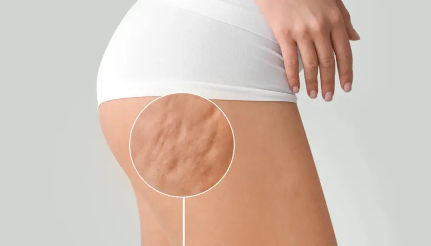 Primo piano della coscia di una donna con cellulite fibrosa visibile, evidenziata da un cerchio.