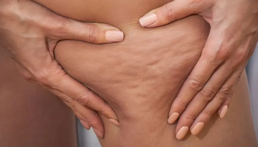 Mani che stringono la pelle mostrando la cellulite edematosa e fibrosa, con rugosità evidenti.