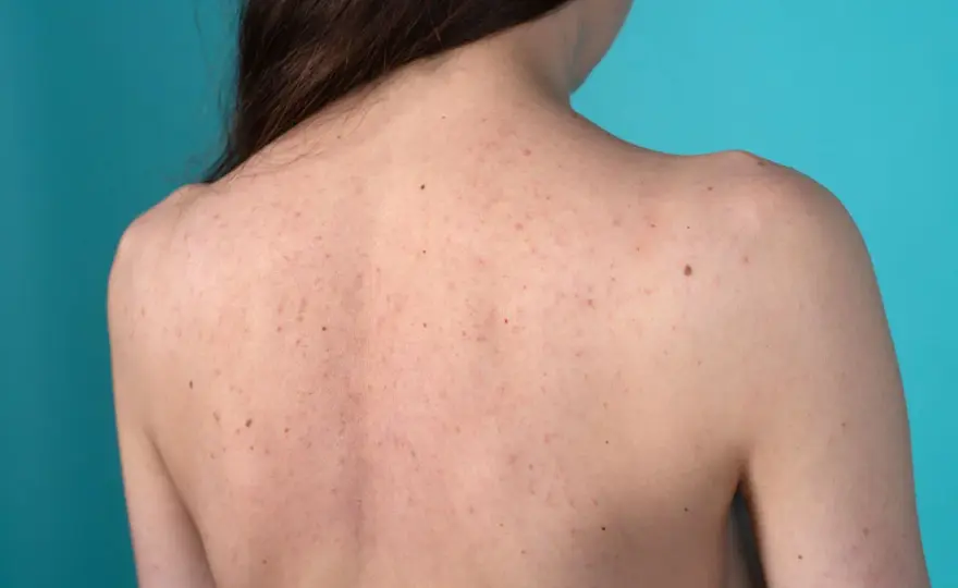 Inestetismi cutanei - Quando preoccuparsi e quando no?