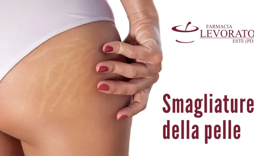 Smagliature cosce interne: cause, rimedi e prevenzione