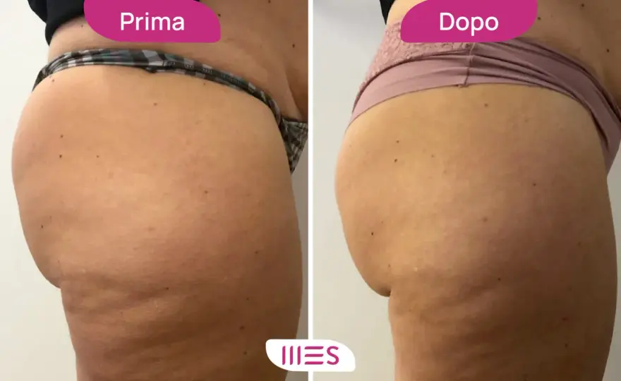 Ozonoterapia cellulite - Costi reali e quante sedute servono