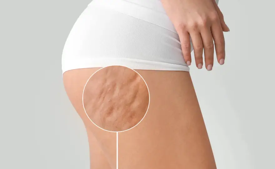 Cellulite fibrosa - Riconoscila e trattala con strategie mirate