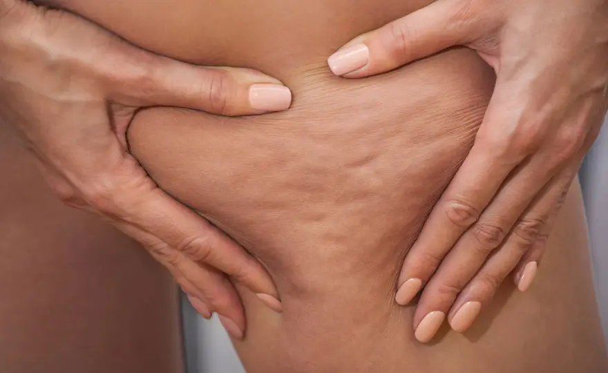 Cellulite edematosa o fibrosa? Riconosci e agisci subito!