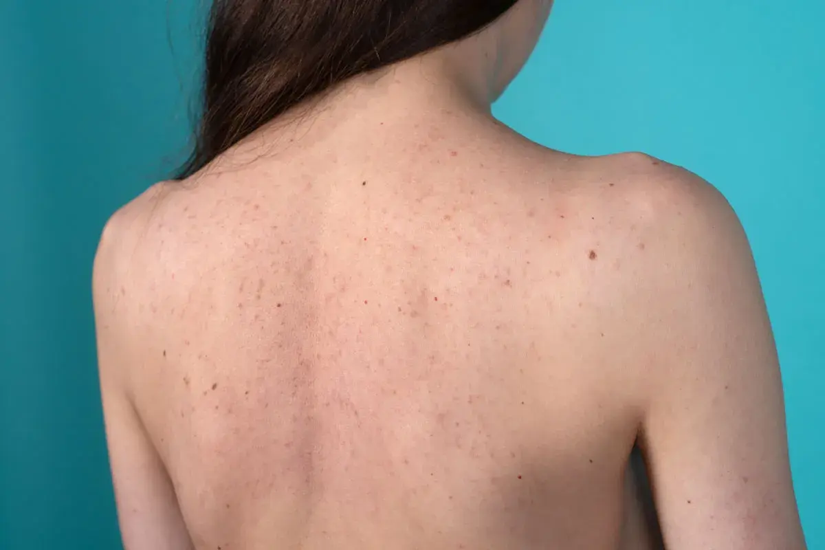 Schiena di una persona con inestetismi cutanei, tra cui brufoli e nei, su sfondo blu.