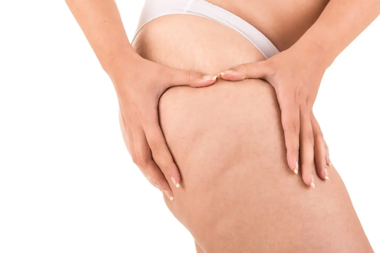 Mani che stringono la coscia, mostrando la texture della pelle e i noduli di cellulite, in un gesto che evoca il desiderio di rompere i noduli di cellulite.