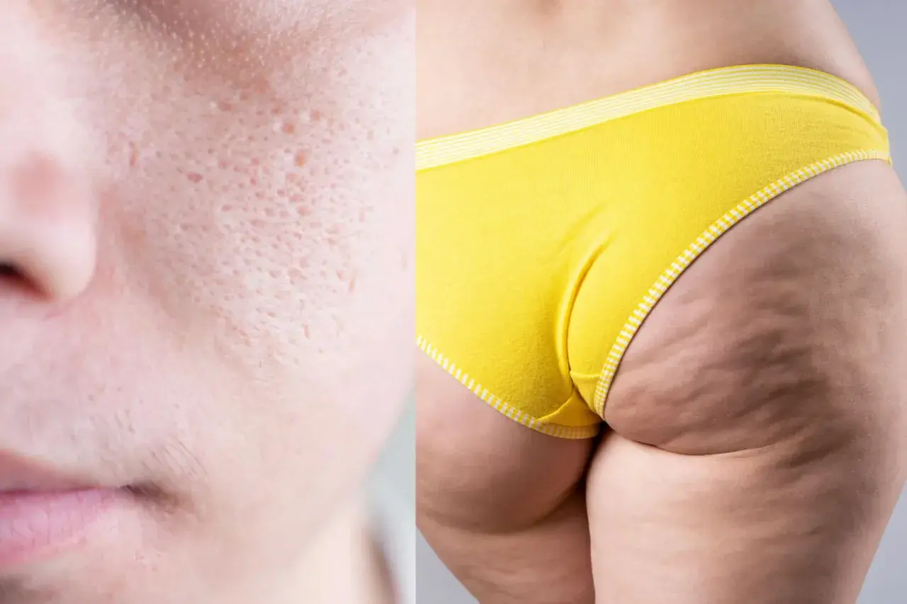 Close-up of skin texture: pitted facial skin on the left, dimpled thigh and buttocks in yellow underwear on the right.