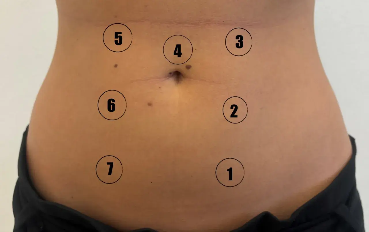 Close-up of a person's abdomen with numbered circles indicating points on the skin.