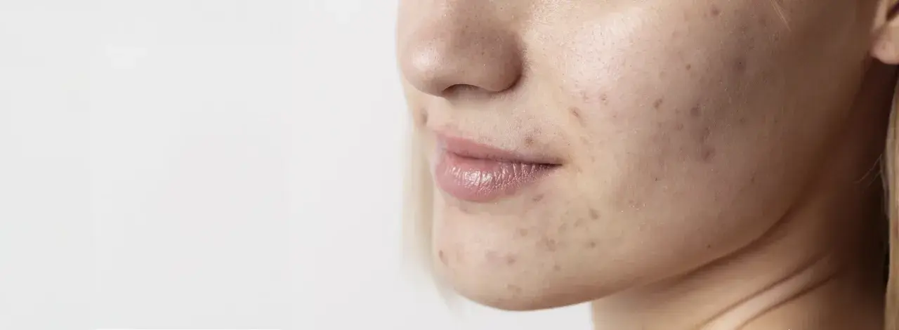 Primo piano del viso di una giovane donna con imperfezioni e smagliature sul viso, che evidenziano la texture della pelle.
