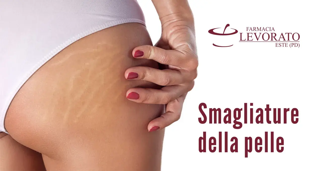 Primo piano di smagliature sull'interno coscia, un inestetismo comune della pelle.