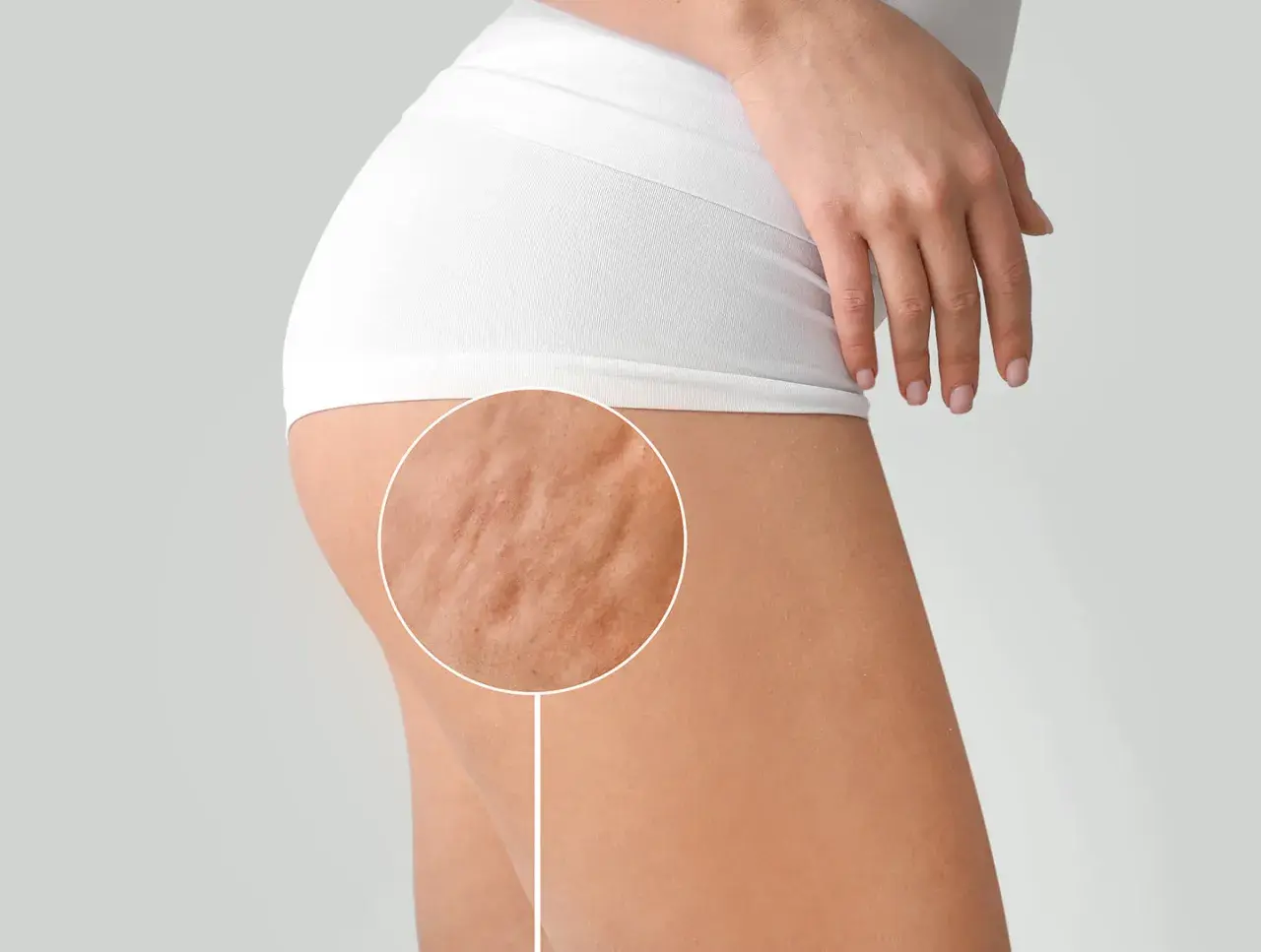 Primo piano della coscia di una donna con cellulite fibrosa visibile, evidenziata da un cerchio.