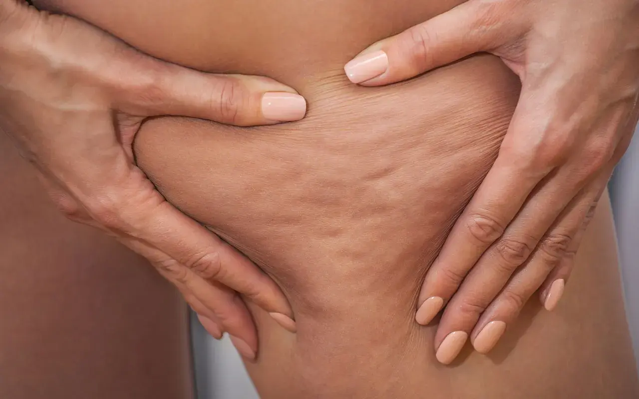 Mani che stringono la pelle mostrando la cellulite edematosa e fibrosa, con rugosità evidenti.