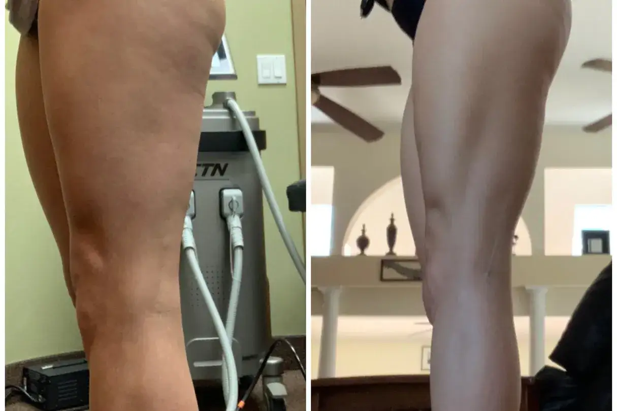 Gambe prima e dopo trattamenti estetici. La pelle appare pi&ugrave; liscia e tonica, risultato di efficaci massaggi dimagranti.