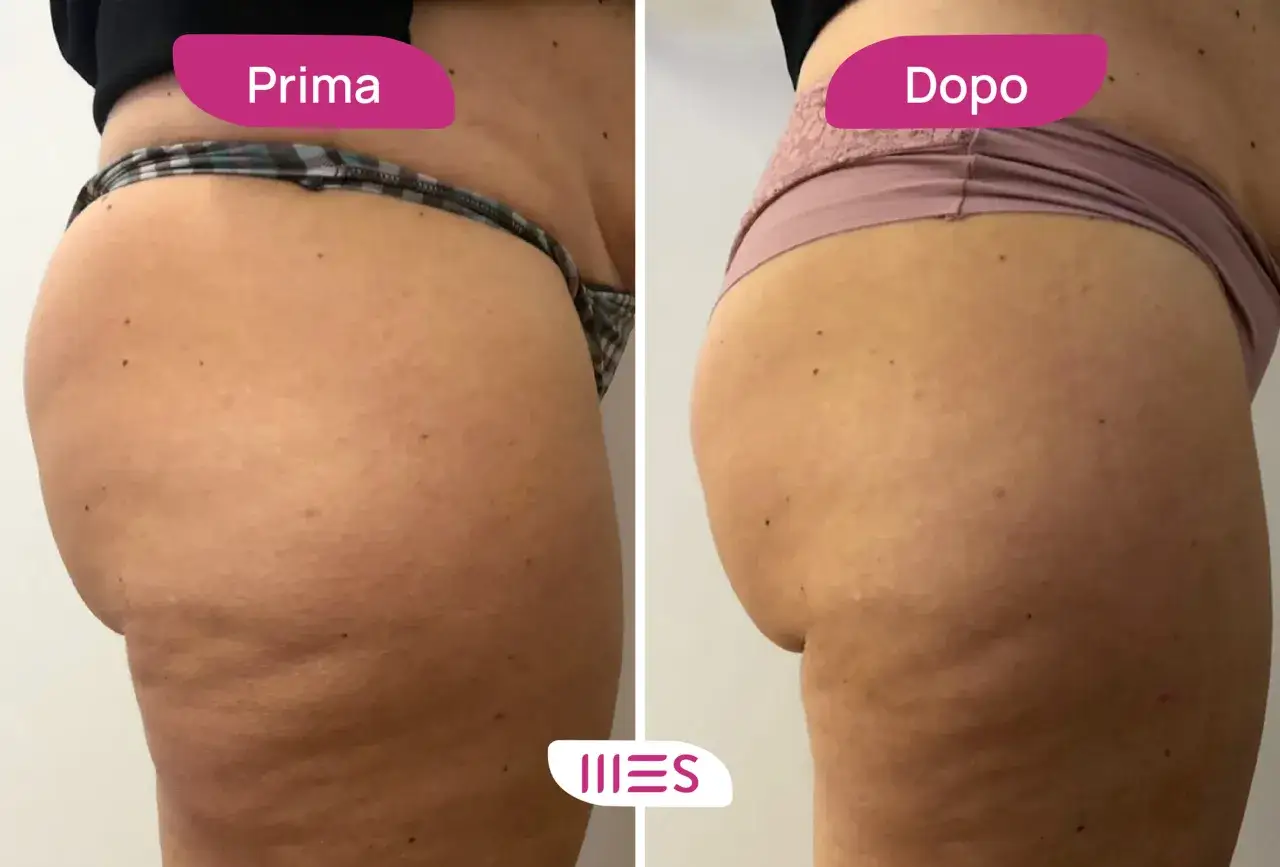 Prima e dopo: miglioramento della cellulite con ozonoterapia. Scopri il ozonoterapia cellulite costo per una pelle pi&ugrave; liscia.