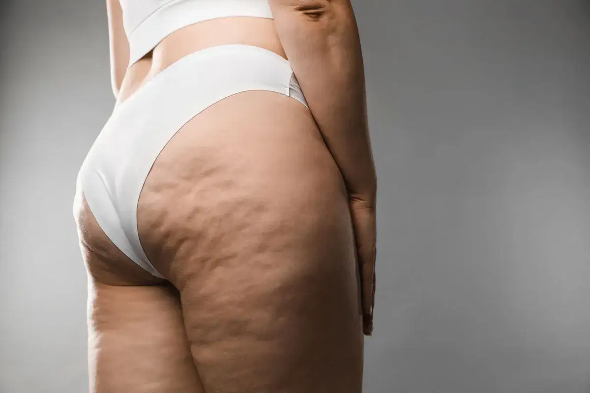 Vista laterale di una coscia con evidente cellulite edematosa e fibrosa, con pelle a buccia d'arancia.