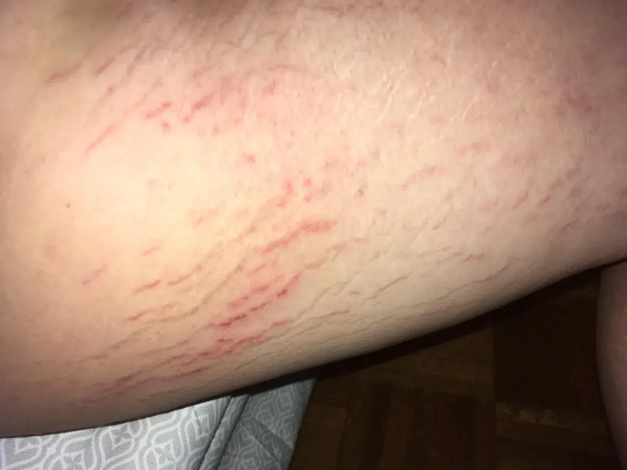 Pelle chiara con evidenti smagliature sull'interno coscia, alcune rosse e altre pi&ugrave; chiare, che disegnano linee ondulate sulla superficie cutanea.