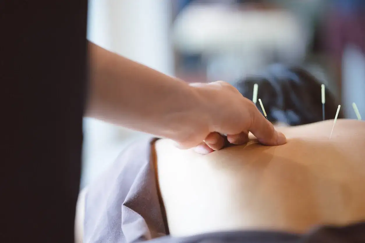 Mani esperte applicano aghi per agopuntura, un trattamento che rientra nel vasto mondo della MTC (Medicina Tradizionale Cinese).