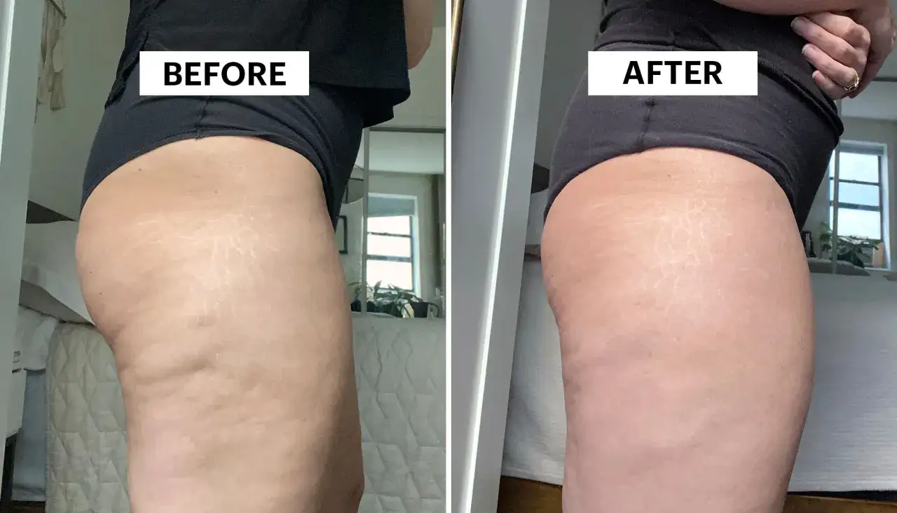 Prima e dopo: miglioramento visibile della cattiva circolazione gambe e cellulite, con pelle pi&ugrave; liscia e uniforme.